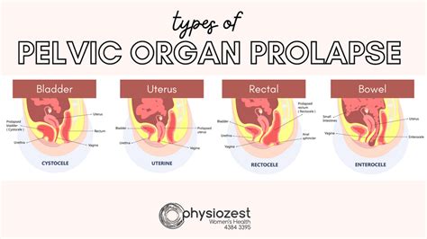 prolapsus gay|Prolaps – Wikipedia